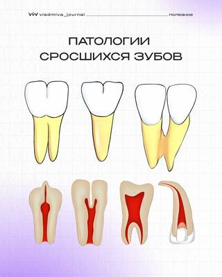 Синодентия: как распознать сращение зубов по карточкам.